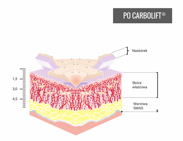 efekty Carbolift