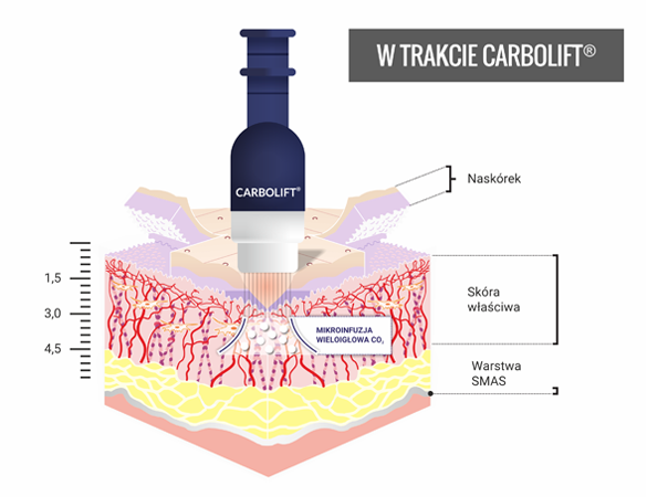 w trakcie Carbolift